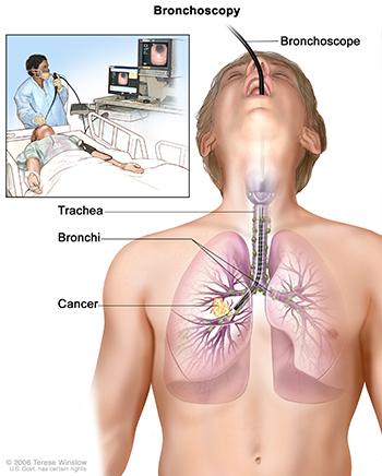 Bronchoscopy picture shows a bronchoscope inserted through the mouth, trachea, and bronchus into the lung; lymph nodes along trachea and bronchi; and cancer in one lung. A small inset picture shows patient lying on a table having a bronchoscopy. Source: Terese Winslow (Illustrator), National Cancer Institute.