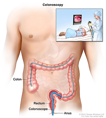 Colonoscopy picture shows a scope inserted through the anus and rectum and into the colon. A small inset picture shows patient on table having a colonoscopy. Source: Terese Winslow (Illustrator), National Cancer Institute.