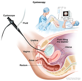 Cystoscopy picture shows a side view of the lower pelvis containing the bladder, uterus, and rectum. Also shown are the vagina and anus. The flexible tube of a cystoscope (a thin, tube-like instrument with a light and a lens for viewing) is shown passing through the urethra and into the bladder. Fluid is used to fill the bladder. A small inset picture shows a woman lying on an examination table with her knees bent and legs apart. She is covered by a drape. The doctor looks at an image of the inner wall of the bladder on a computer monitor. Source: Terese Winslow (Illustrator), National Cancer Institute.