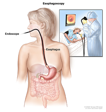 Esophagoscopy picture shows a scope inserted through the mouth and into the esophagus. A small inset picture shows patient on table having an esophagoscopy. Source: Terese Winslow (Illustrator), National Cancer Institute.