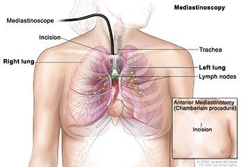 Mediastinoscopy picture shows a scope with light and lens inserted into the chest through an incision above the breastbone. Drawing shows right and left lungs, trachea, and lymph nodes. A small inset picture shows anterior mediastinotomy (Chamberlain procedure) with incision beside the breastbone. Source: Terese Winslow (Illustrator), National Cancer Institute.
