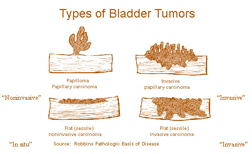 Illustrations of the different types of bladder tumors