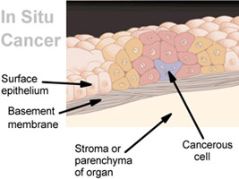 Depiction of an in situ tumor