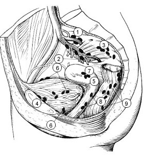 Illustration of the female pelvis showing the positions of the lymph nodes