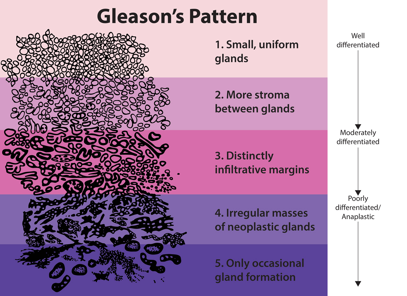 Gleason's Pattern: 1. Small, uniform glands 2. More stroma between glands 3. Distinctly infiltrative margins 4. Irregular masses of neoplastic glands 5. Only occastional gland formation