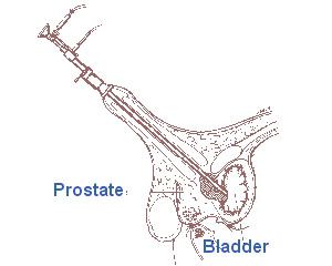 Illustraiton of the prostate and bladder