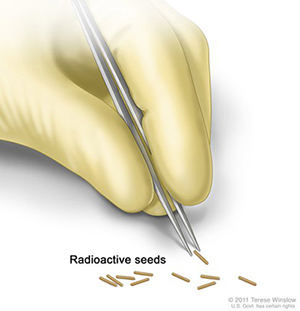 Radioactive seeds; drawing shows a gloved hand using an instrument to pick up small, radioactive seeds.