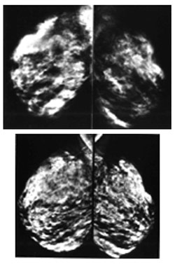 (Top) Breast images using conventional mammography. (Bottom) Digital mammography images of the same woman. Images courtesy of Dr. Laurie Fajardo, Johns Hopkins Medical Institutions