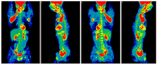 PET scans. Uptake of tracer in the lymph nodes involved with lymphoma in the groin, both axilla, and neck (red areas). Source: Dr. Jorge Carrasquillo, Nuclear Medicine Department, Clinical Center, National Institutes of Health