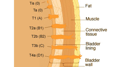 Illustration of the bladder showing the TNM classifications.