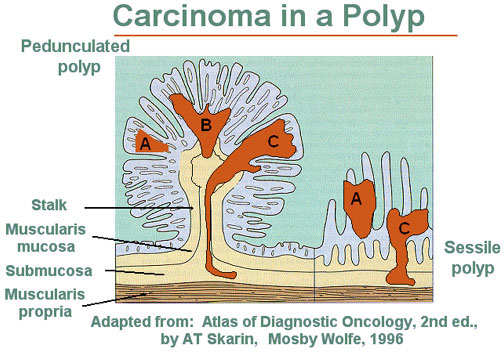 Illustration of a carcinoma in a polyp