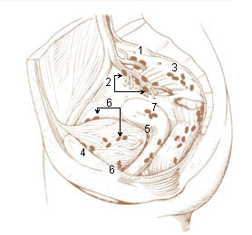 Numbered illustration of the internal iliac and perivesicular lymph nodes