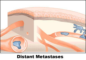 Distant Metastases.