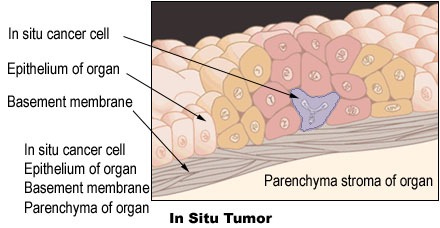 Illustration of an in situ tumor with arrows identifying in situ cancer cell, epithelium of organ, and basement membrane.
