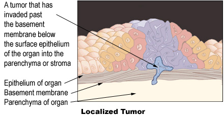 Illustration of a localized tumor with arrows identifying the epithelium of organ, basement membrane, parenchyma of organ, and a tumor that has invaded past the basement membrane below the surface epithelium of the organ into the parenchyma or stroma.
