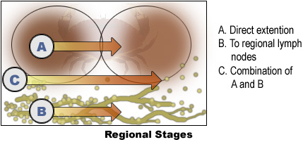 Image of the three different Regional Stages: A. Direct extention, B. To regional lymph nodes, C. Combination of A and B.